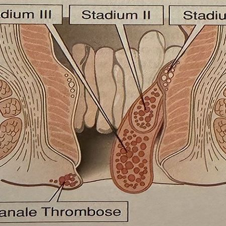 Stadien von Hämorrhoiden