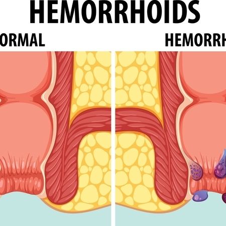 Mit und ohne Hämorrhoiden